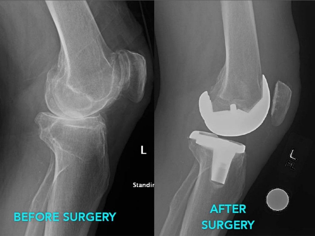 Knee Revision Surgery