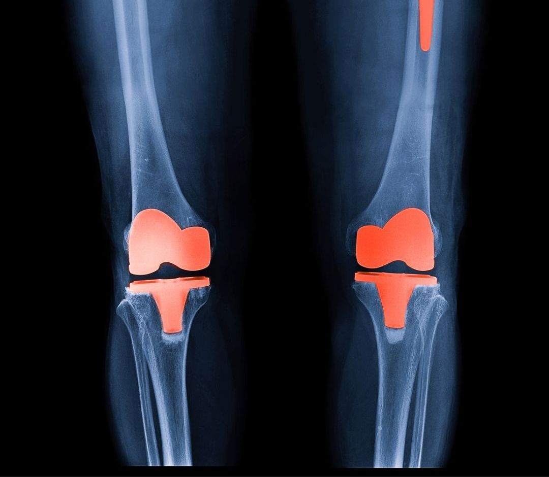 Knee Scope Surgery