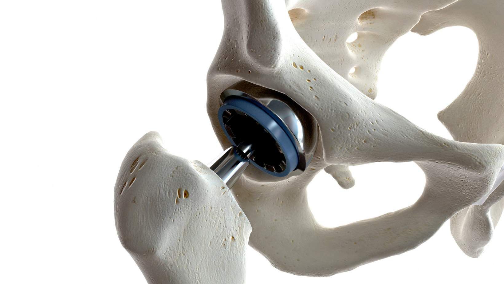 Prosthetic joints image