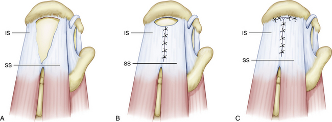 Rotator cuff - Side to side repair image