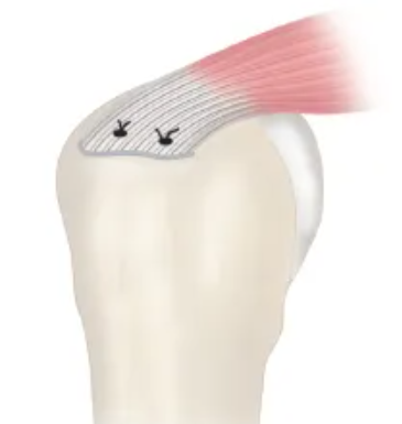 Rotator Cuff Single row repair
