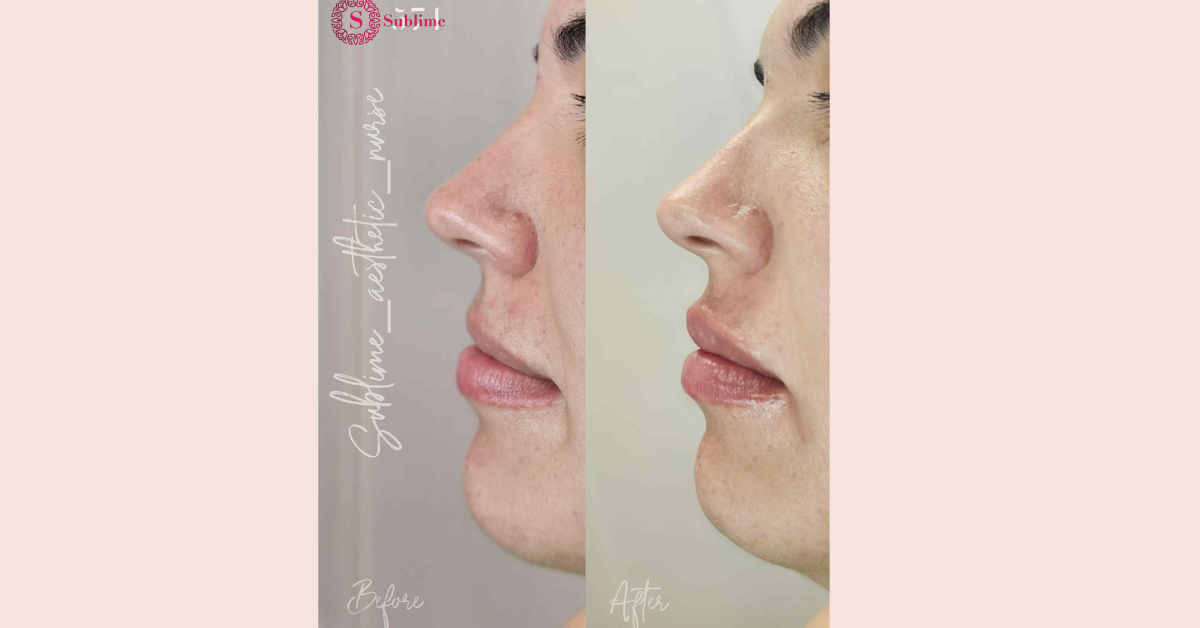 lip filler