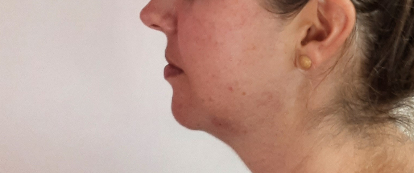 lip filler sublime571 Auckland