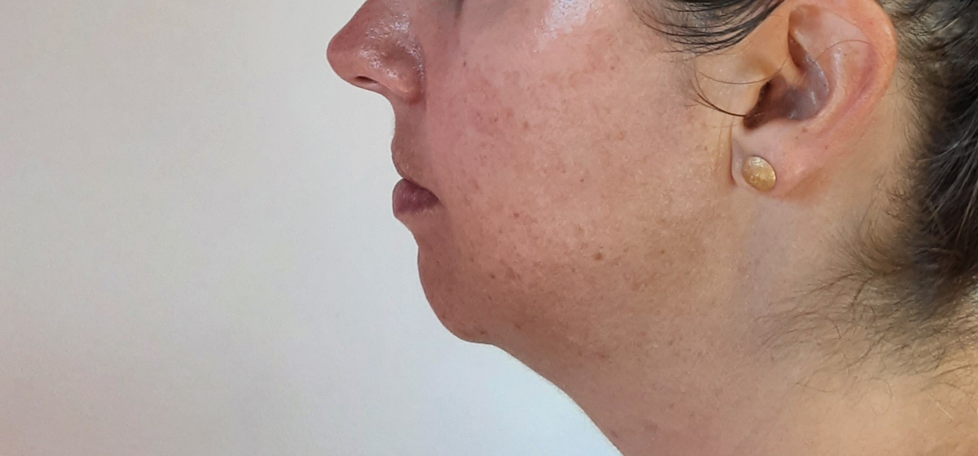 chin-filler-auckland