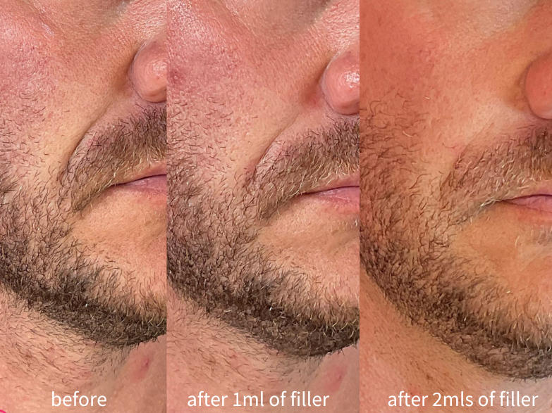 Dermal filler results midface North Auckland