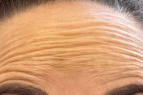 botox auckland