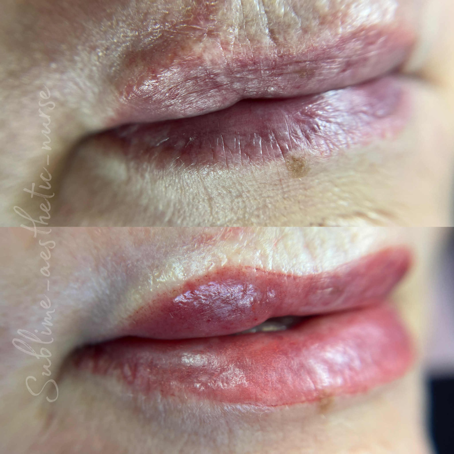 Lip cosmetic tattoo 