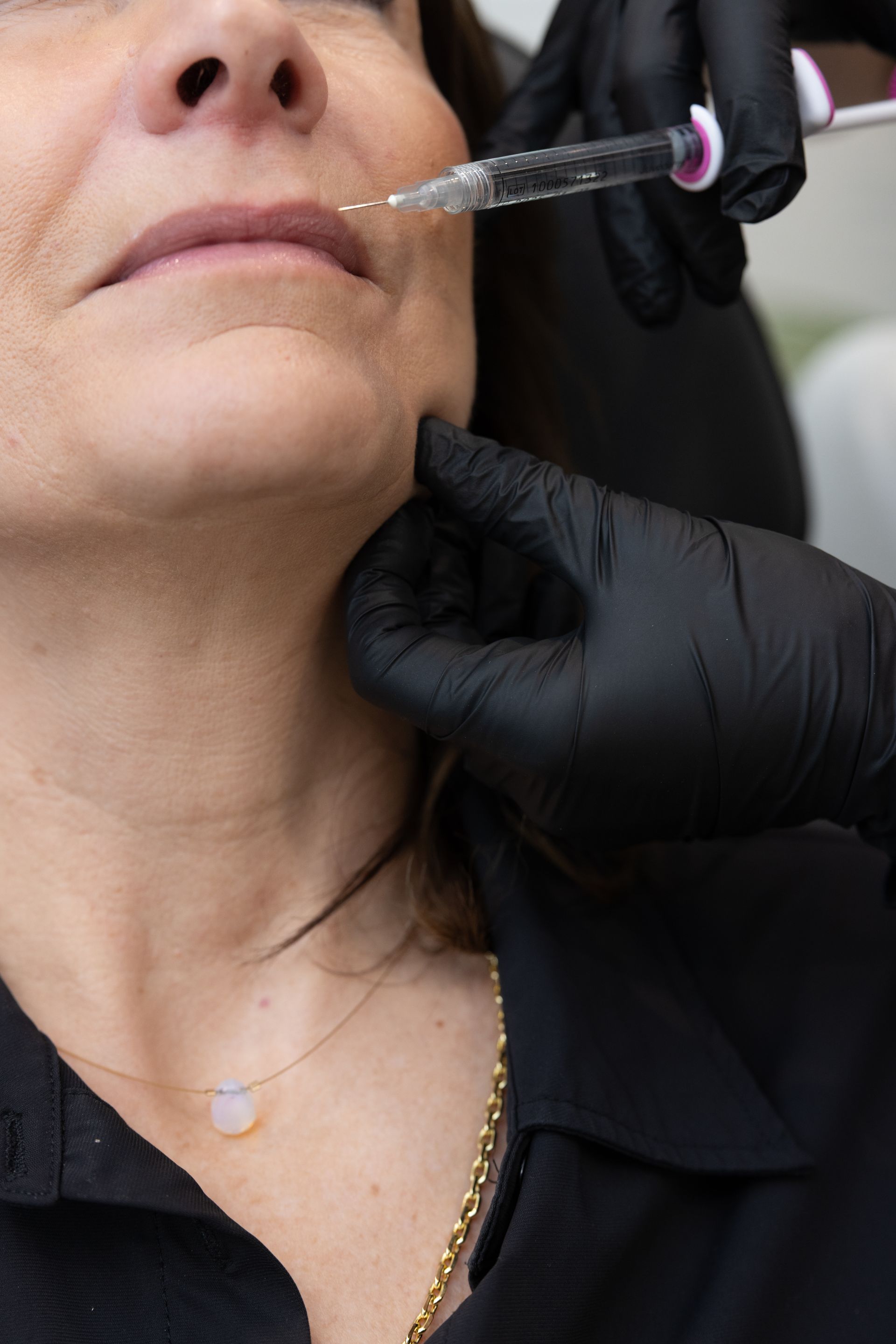 Close-up of a woman receiving a cosmetic lip treatment with a syringe while wearing black gloves