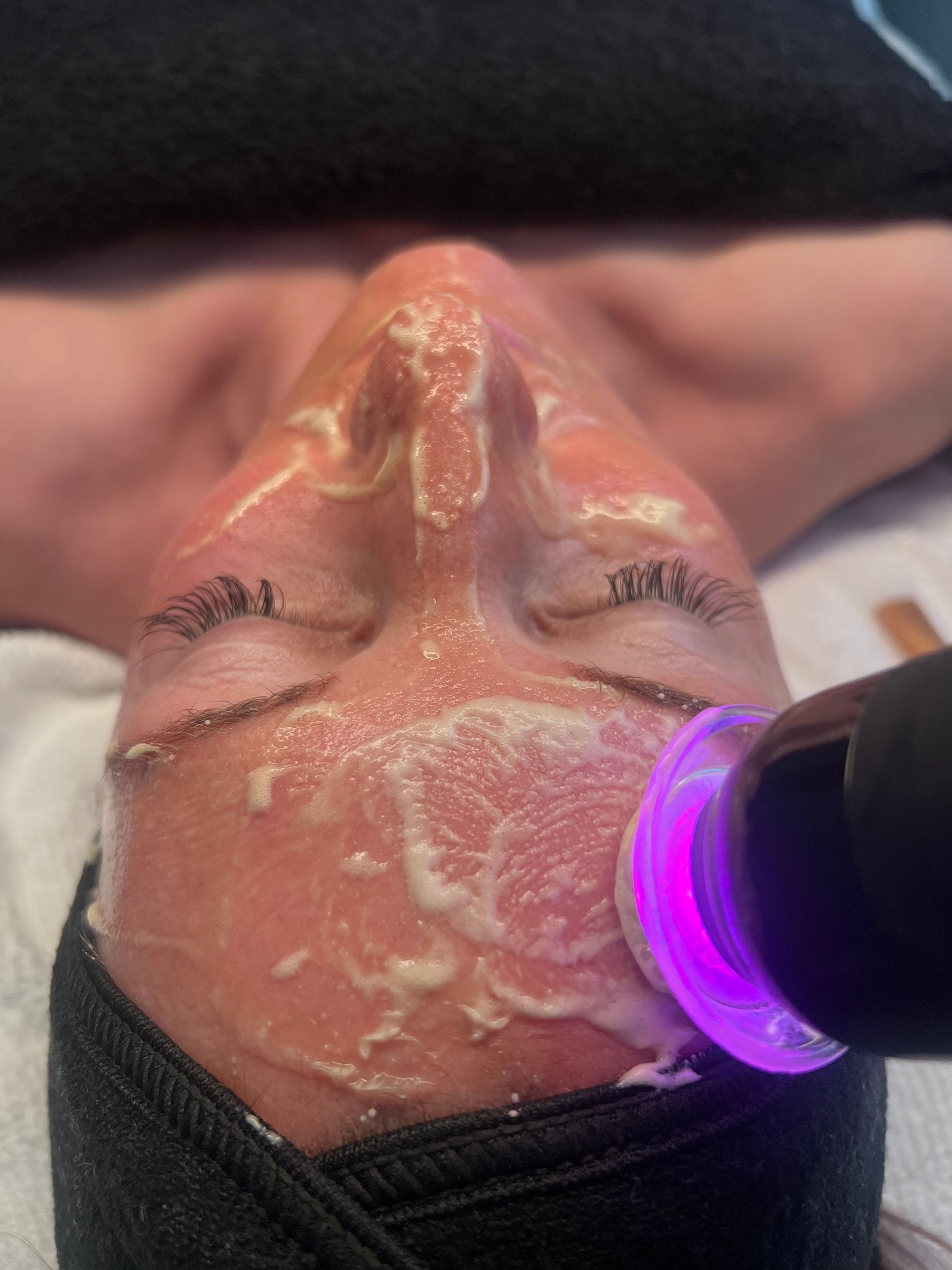 Person receiving a facial treatment with a glowing purple device and cream on the face