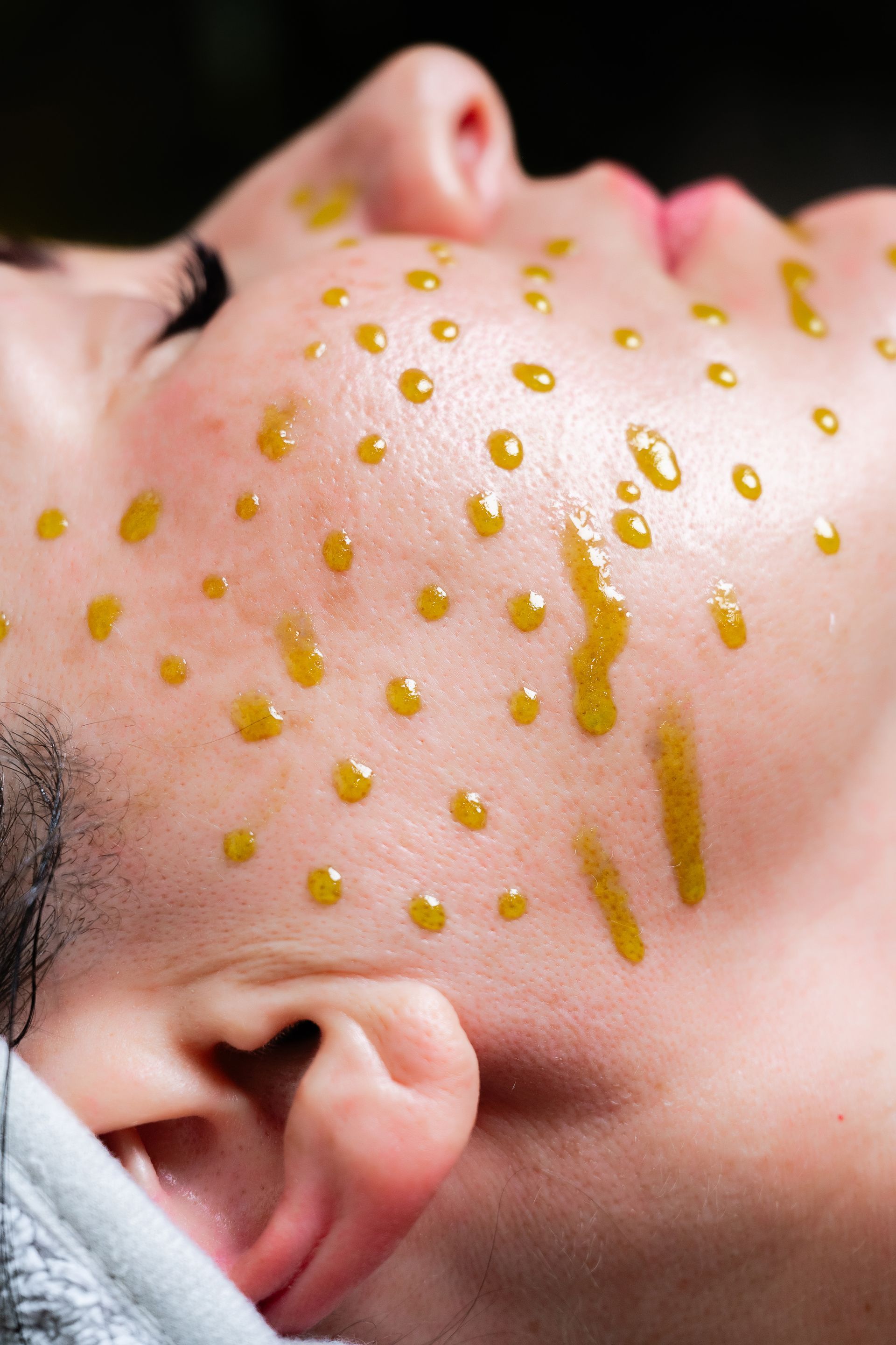 Close-up of a person’s face with yellow oil droplets on the cheek and forehead during a skincare treatment