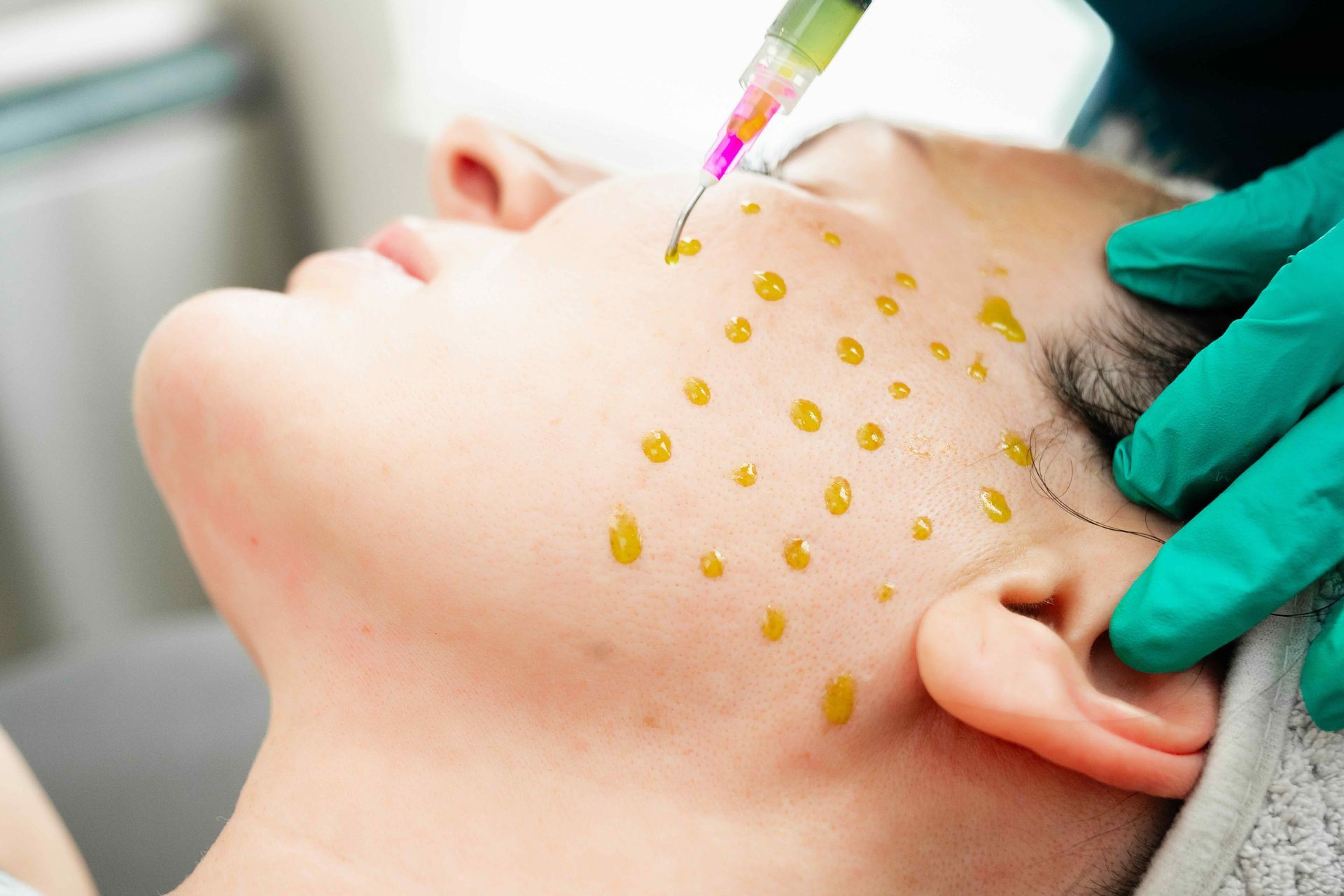 Close-up of a face with yellow dots being applied by a gloved hand with a dropper