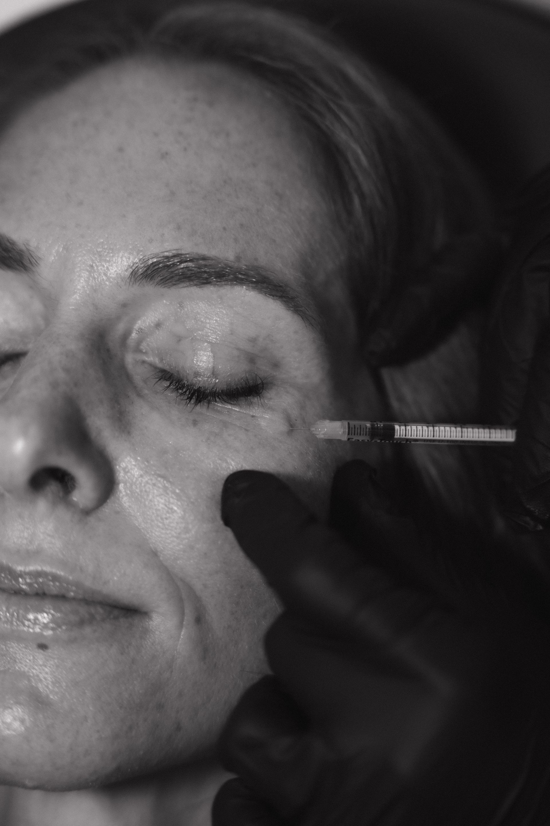 Close-up of a person’s face with eyes closed while a gloved hand applies a facial treatment with a syringe