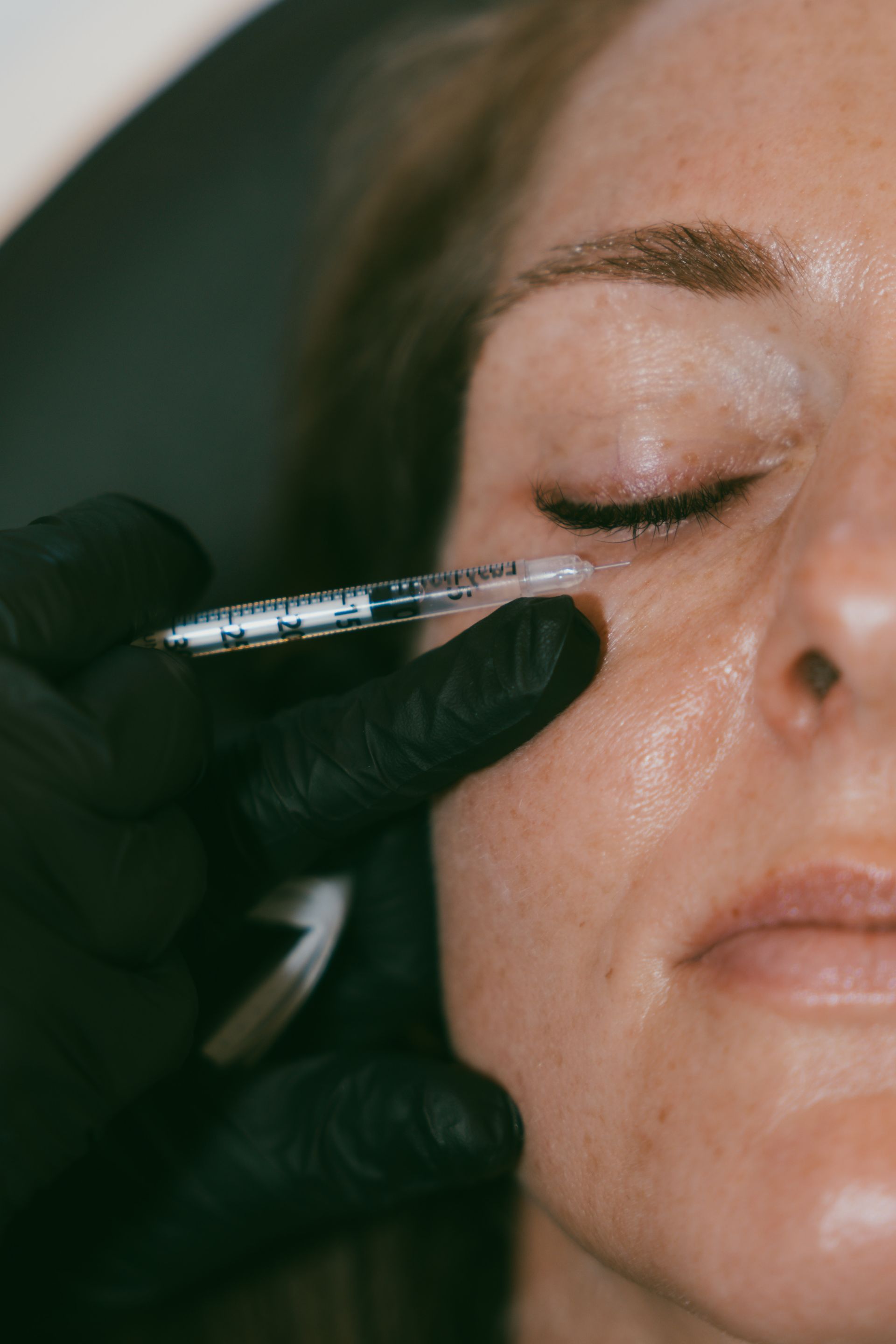 Gloved hand injecting filler under a woman's eye with a syringe
