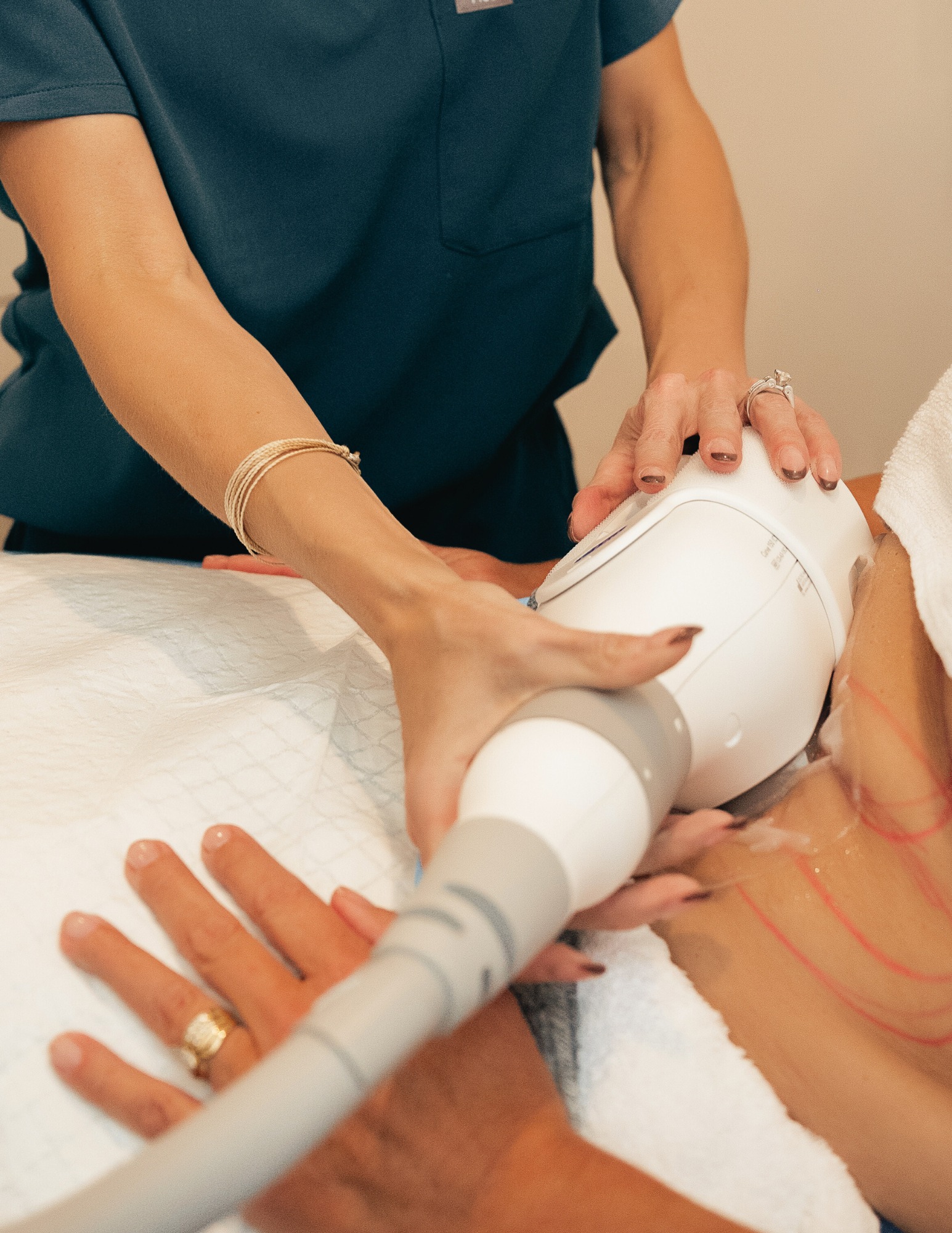 CoolSculpting