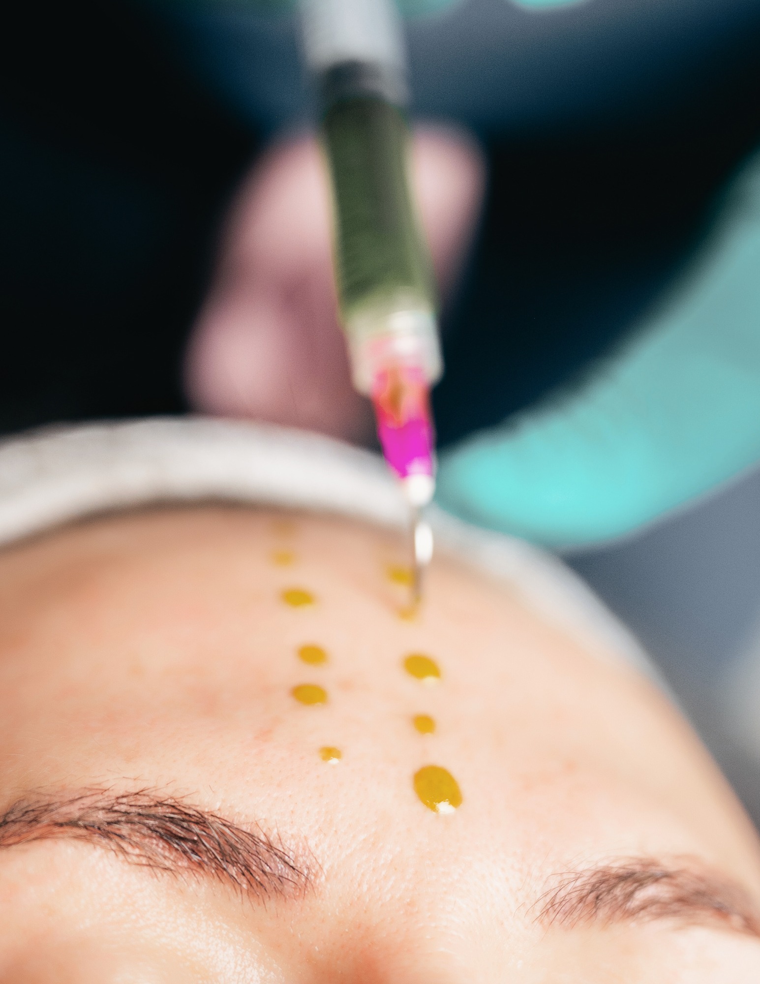 Chemical Peels