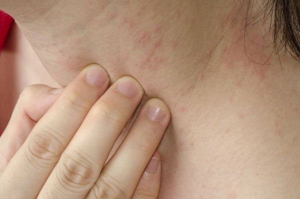 Sintomas de una alergia