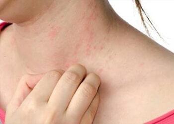 DR. SERGIO CARVAJAL ABDALA – URTICARIA O RONCHAS