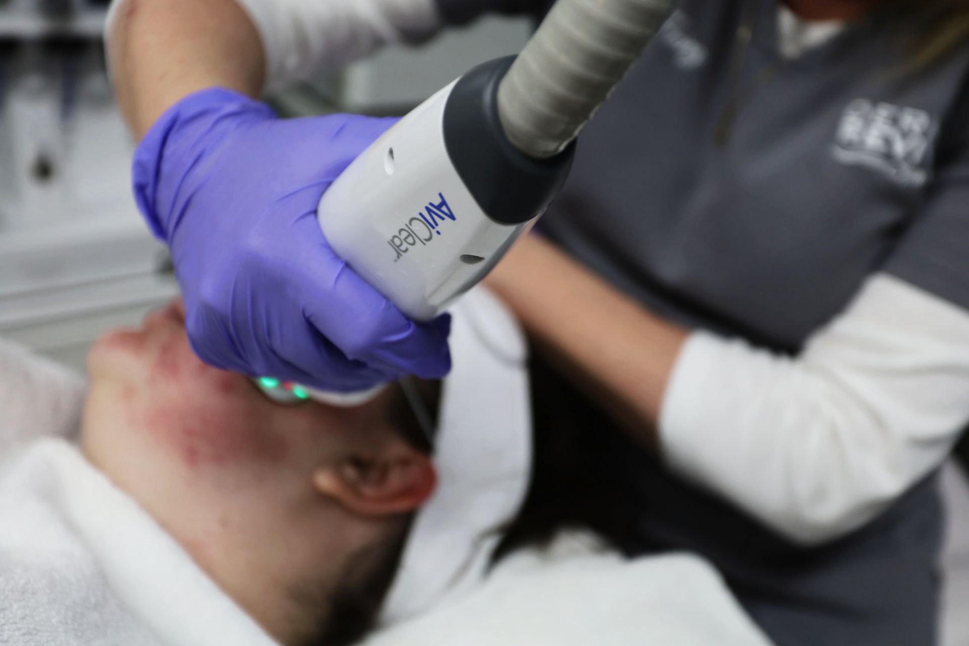 aviclear treatment