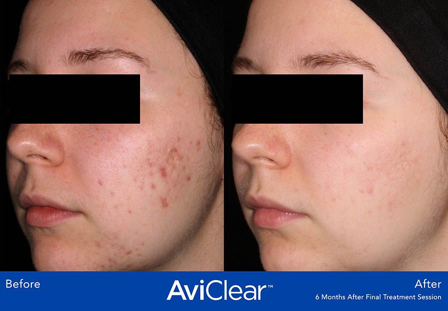 before and after aviclear treatment before and after aviclear treatment