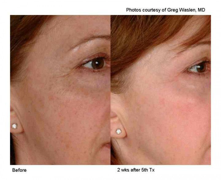 before and after skin rejuvenation before and after skin rejuvenation