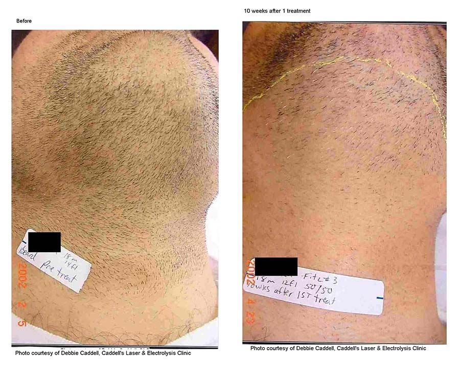 before and after laser hair reduction