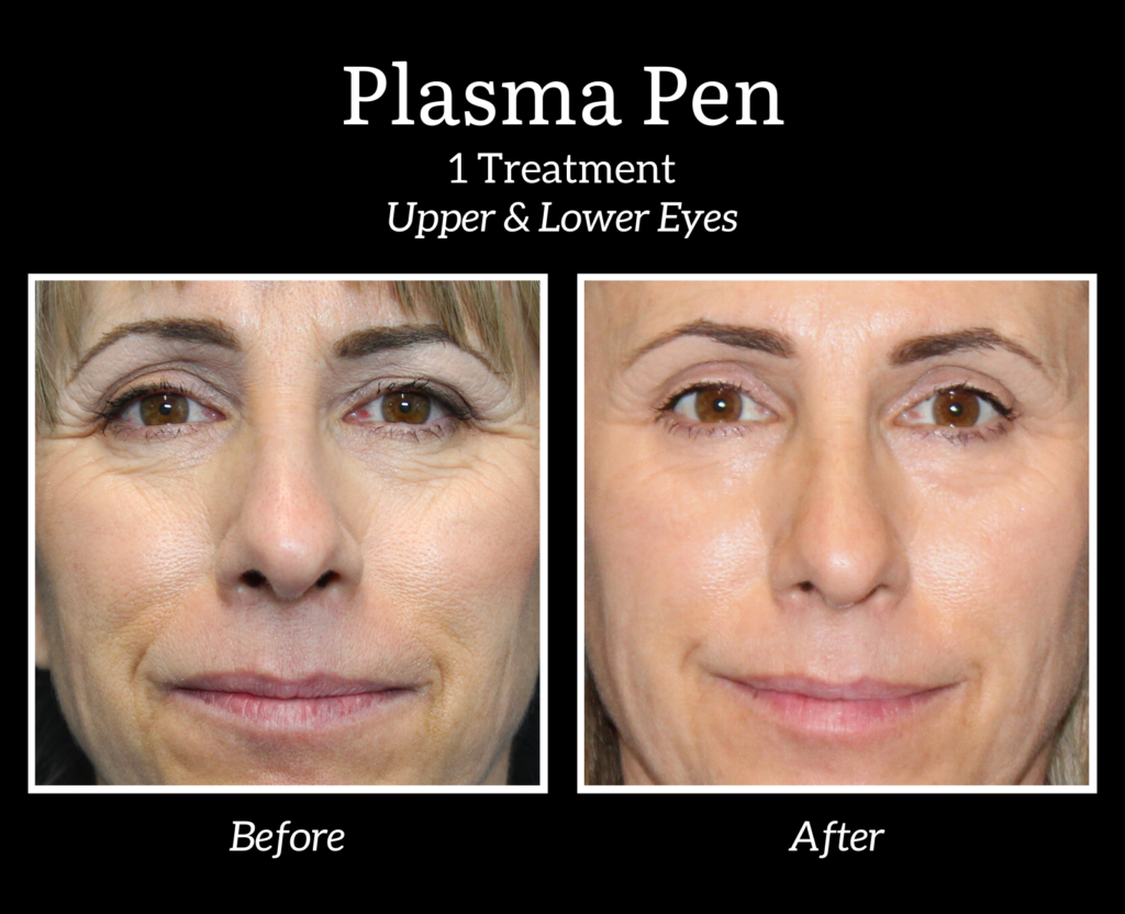 A woman 's face before and after a plasma pen treatment