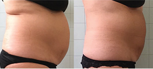 A before and after picture of a woman 's stomach.