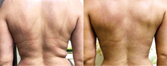 A before and after picture of a woman 's back.