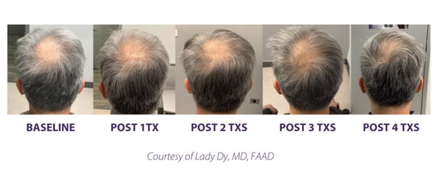 A picture of a man 's head showing the stages of hair loss