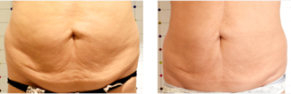 A before and after picture of a woman 's stomach