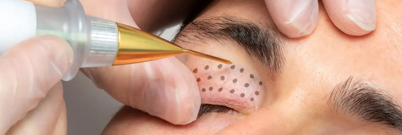 A close up of a person getting a treatment on their eye.
