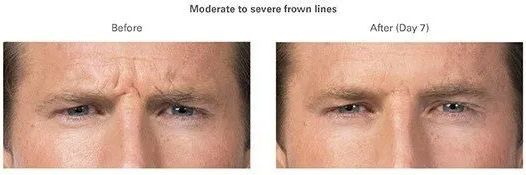 A before and after picture of a man 's forehead with wrinkles.