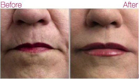 A before and after photo of a woman 's face