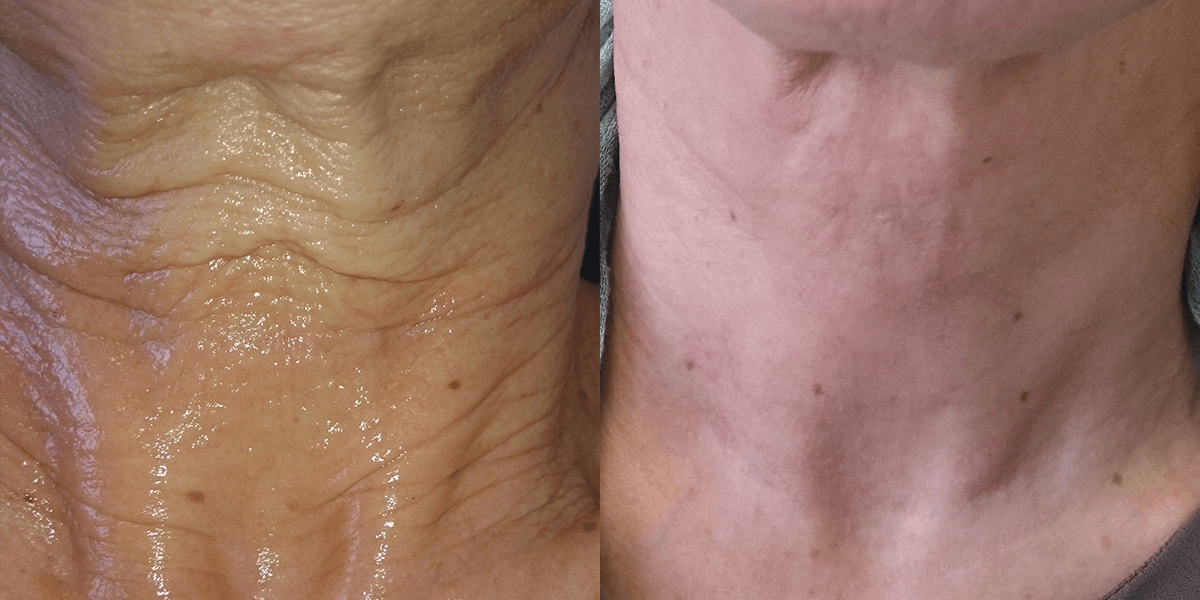 A before and after photo of a woman 's neck and neckline.