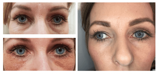 A before and after photo of a woman 's eyes.