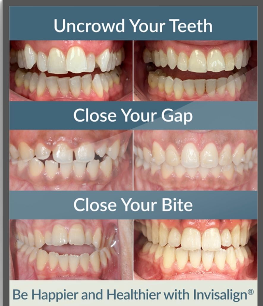 Side-by-side comparison of teeth, pre and post-Invisalign treatment, showing improved alignment and bite.