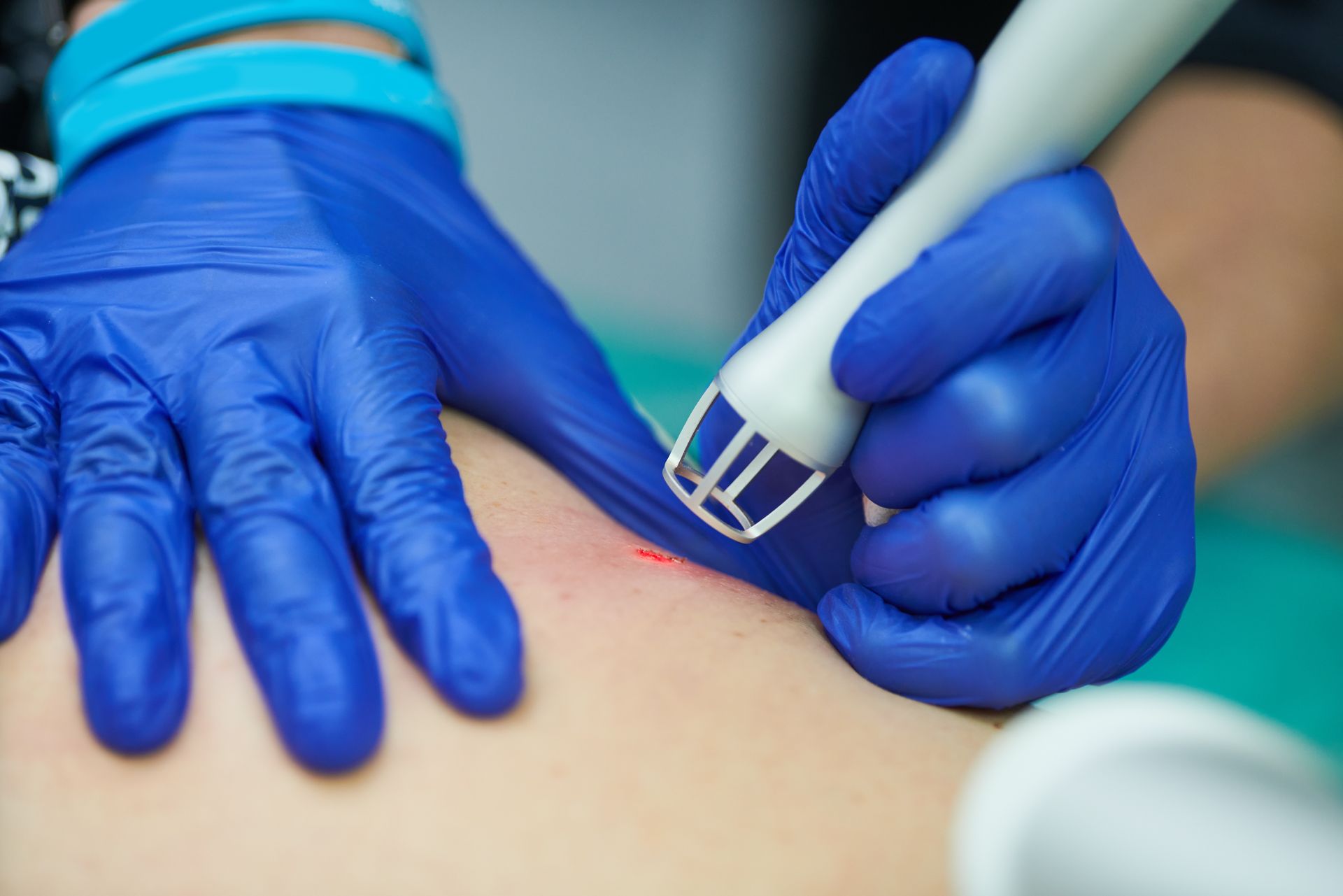 A person is getting a laser treatment on their back.