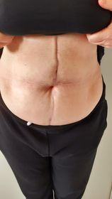 De buik van een persoon met een chirurgisch litteken. De persoon draagt een zwarte broek en op de buik is een verticaal litteken en een lichte uitstulping te zien.