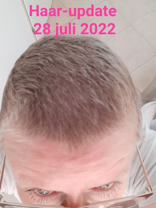 Bovenaanzicht van een hoofd, waarop een terugtrekkende haarlijn te zien is. Tekst: