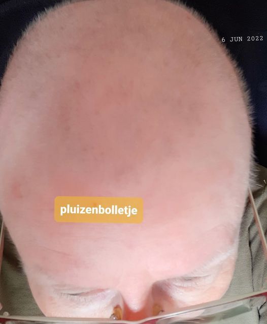 Close-up van een geschoren hoofd met de tekst