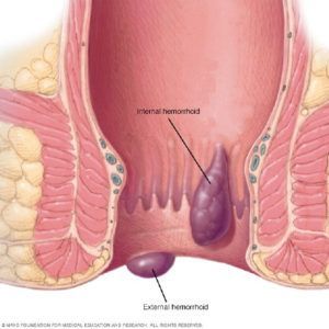 Hemorrhoids and Hemorrhoid Treatment