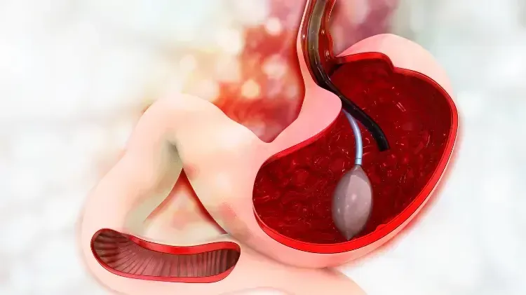 Gastric Balloon and Fatty Liver: Can Weight Loss Help Your Liver?