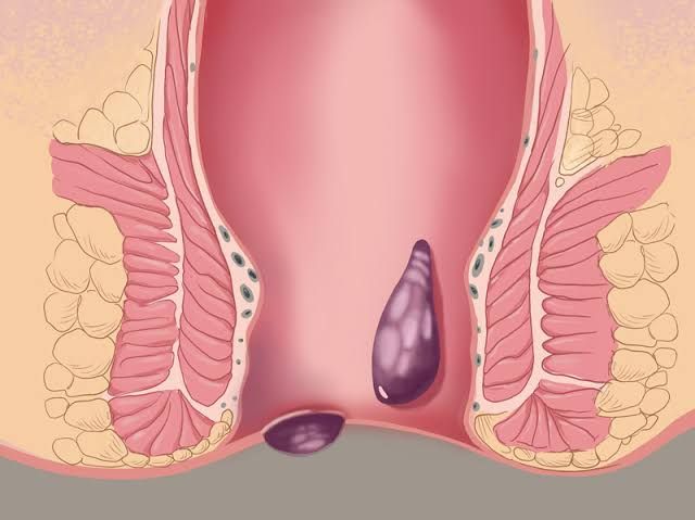 Recovery After Hemorrhoid Banding: What to Expect