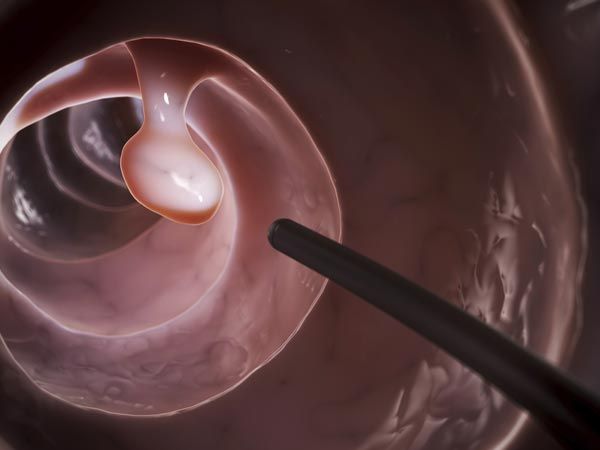 Endoscopía digestiva