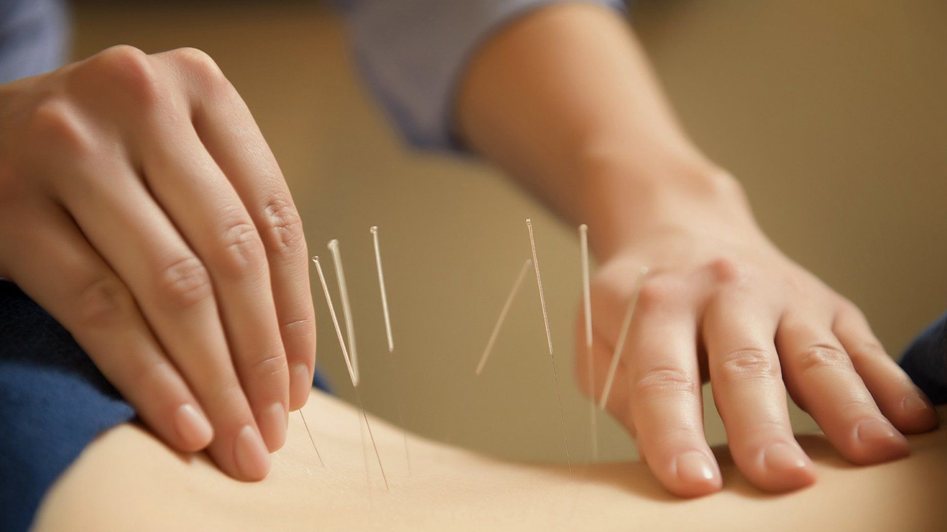 Acupuntura