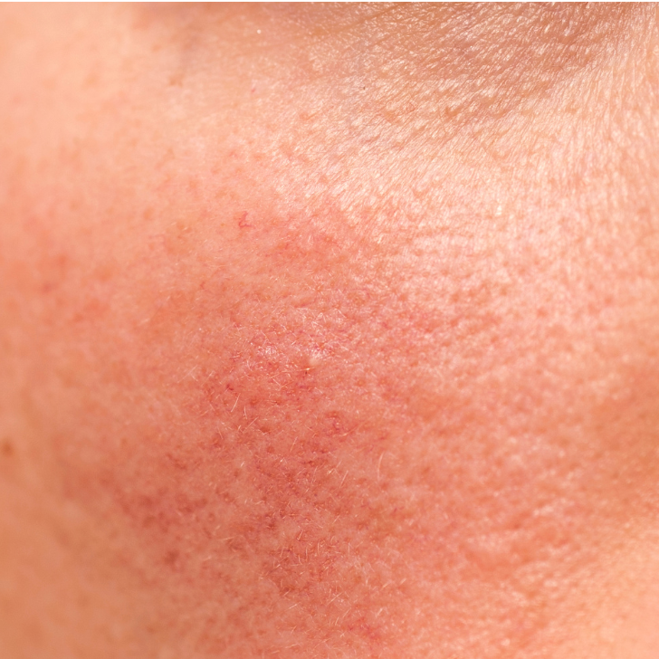 Redness treatment in Metairie | Roascea treatment | Chronos