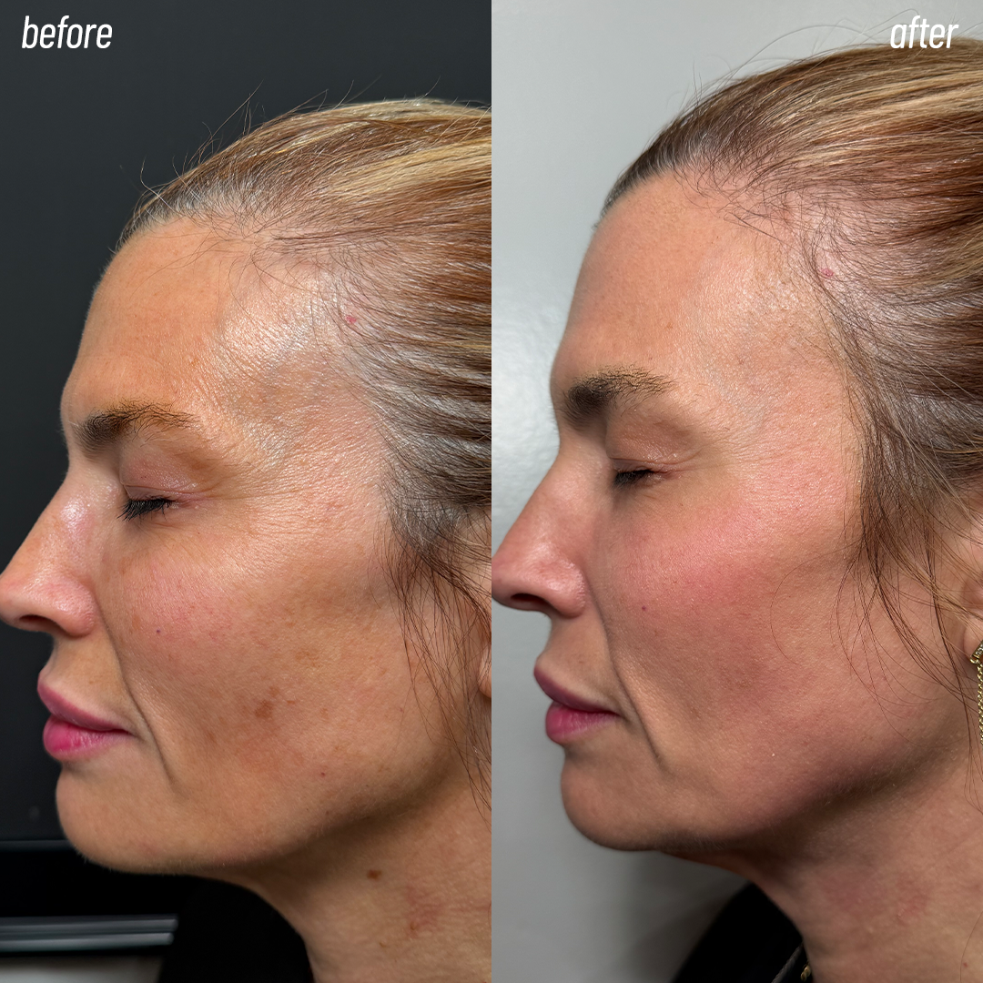 MOXI anti-aging laser in Metairie and New Orleans | Anti-aging laser | Chronos