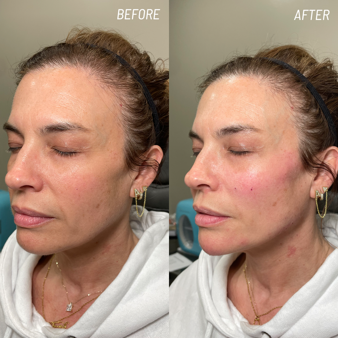 Dermal filler in Metairie | Cheek, jaw, lip filler | Chronos