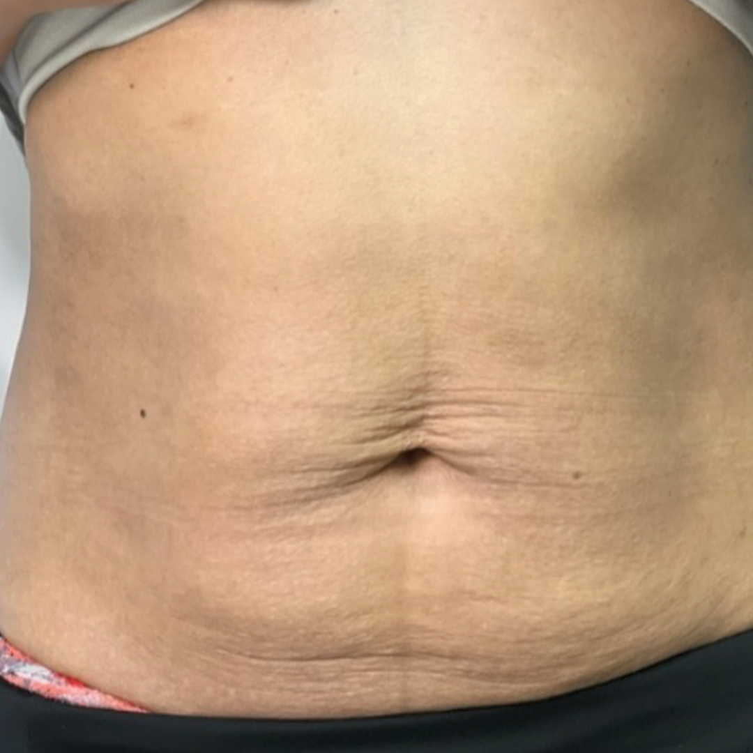 Body RF Abdomen skin tightening before | Virtue RF| Metairie, LA