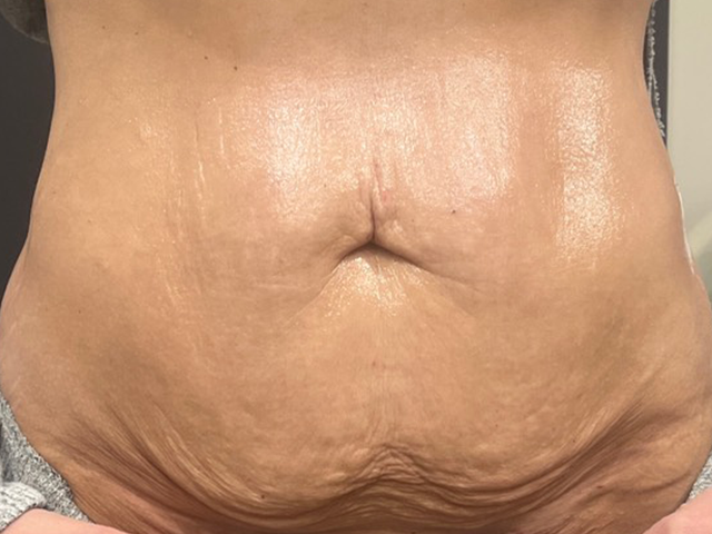recommend a no-downtime option for loose skin after tirzepatide. laxity weight loss isnt just about tightening  its about restoring skin quality., This result is 3 months after RF microneedling., Treatment was tailored to the tissue, not rushed, not Non-Surgical Abdominal Fat Reduction in